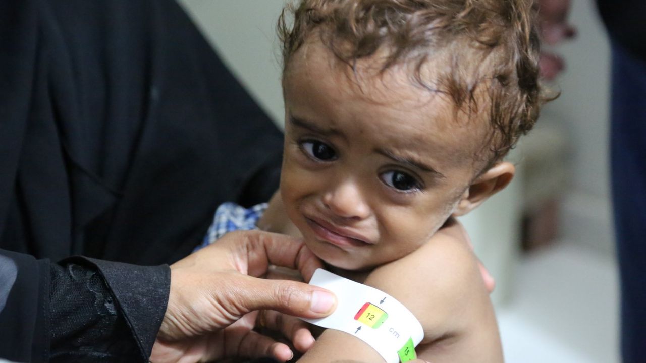 Yemen'de 77 çocuk kızamıktan yaşamını yitirdi