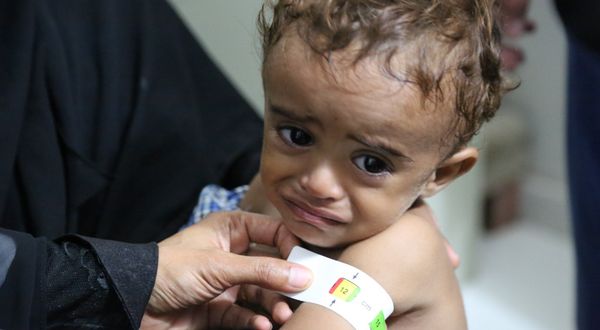 DSÖ'den Yemen'de artan kızamık ve çocuk felci vakalarına karşı uyarı
