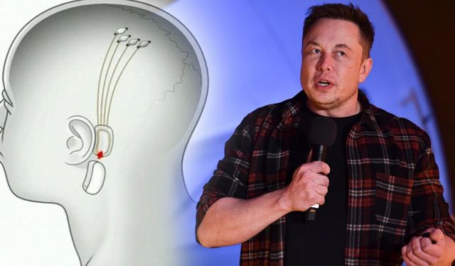 Elon Musk, insan beynine çip takmak için izin aldı